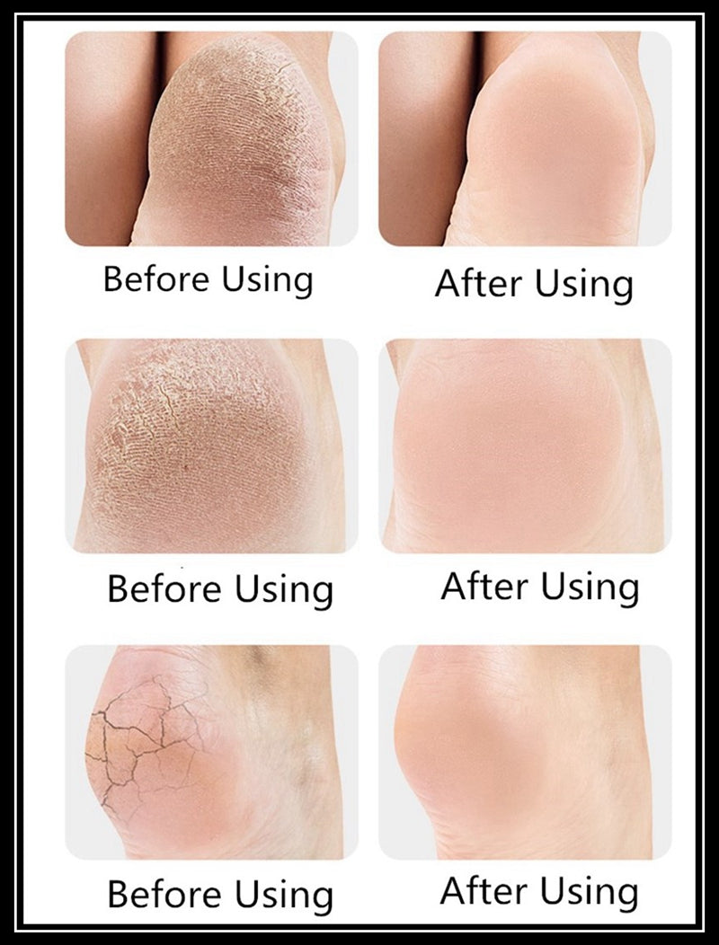 Anti-Crack Heal Set - Pair - My Store